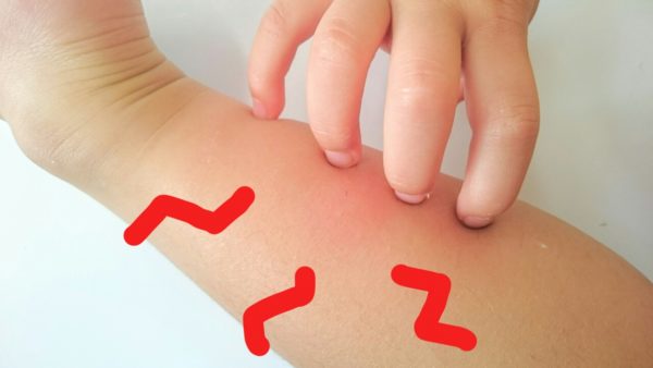 子どもの擦り傷の周りに水疱が それは とびひ の症状かも 治療法は うつるの ママ広場 Mamahiroba 小学生 園児ママの悩みの解決の糸口に