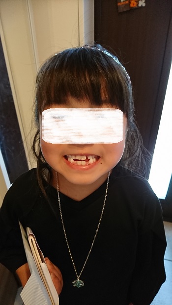 歯の矯正は本人の努力も必要 小2で受け口 反対咬合 の矯正開始 2年経った現在は ママ広場 Mamahiroba 小学生 園児ママの悩みの解決の糸口に